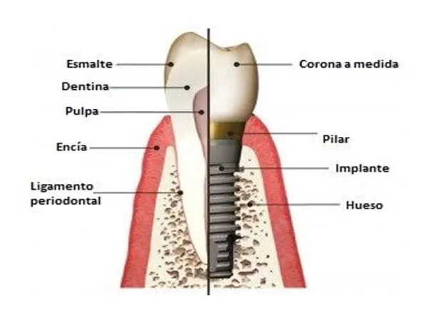 Con este sistema podemos remplazar una pieza, varias o arcadas completas