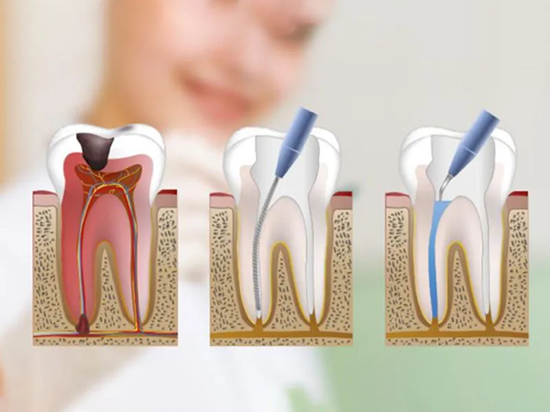 Endodoncia 