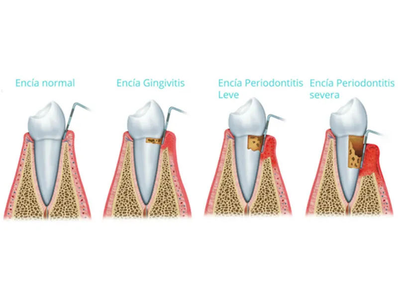 Periodoncia 