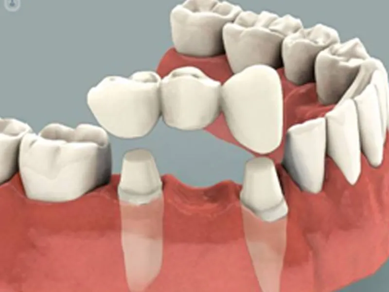 Prótesis dentales 